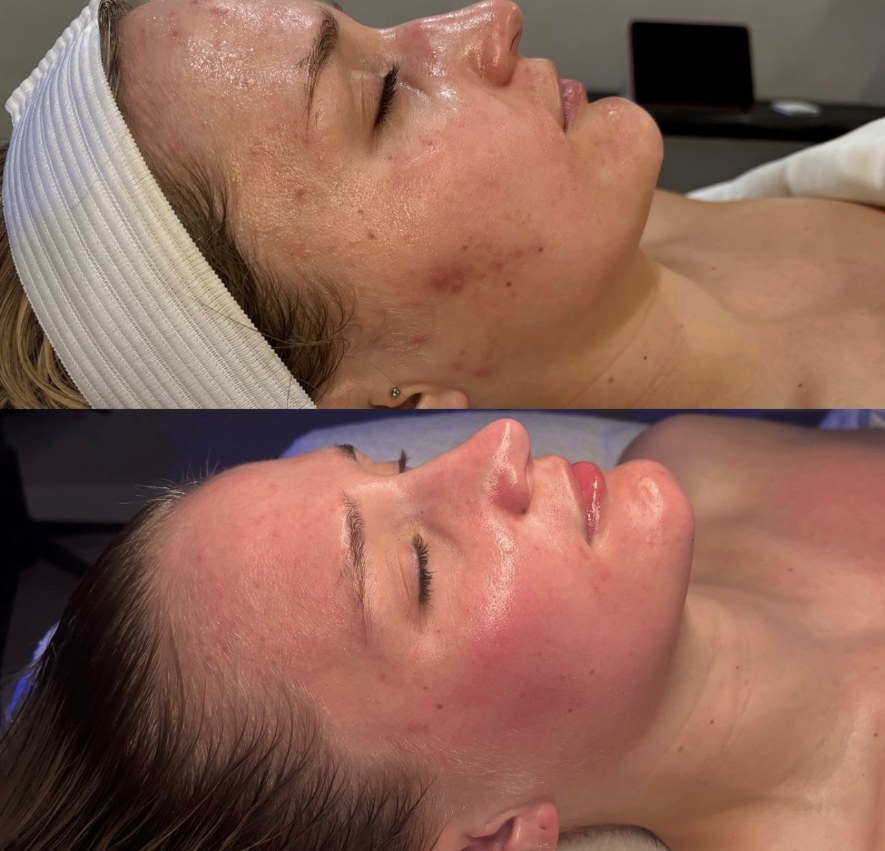 Tratamientos con Microneedling